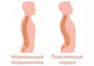 Что такое гиперлордоз и как его лечить
