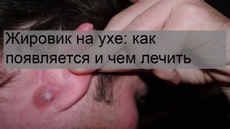 Что такое жировик в ухе и как с ним бороться