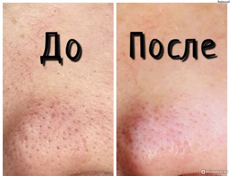 Шаг 3: Удаление черных точек шприцом
