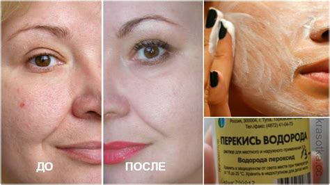 Эффективность перекиси водорода для осветления кожи