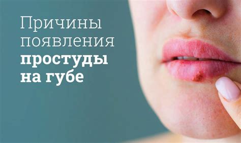 Эффективные методы избавления от простуды на губе без задержек