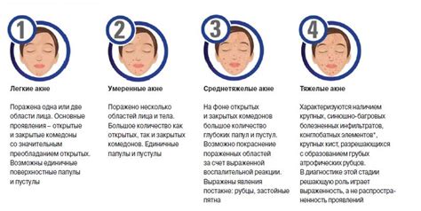 Эффективные методы лечения акне