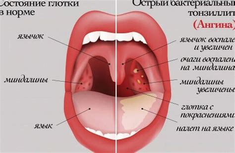 Эффективные методы облегчения горла