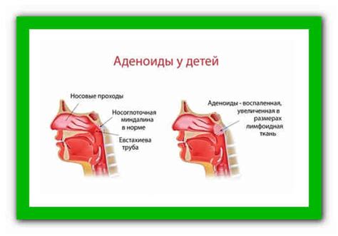 Эффективные средства для очистки аденоидов