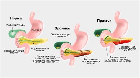  Риск развития панкреатита без желчного пузыря и при употреблении алкоголя 